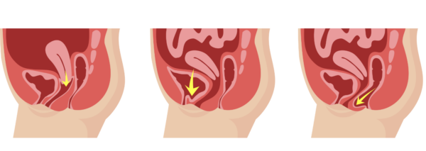 Cigonia | Center of expertise in perineal and pediatric rehabilitation | Pessary Cigonia