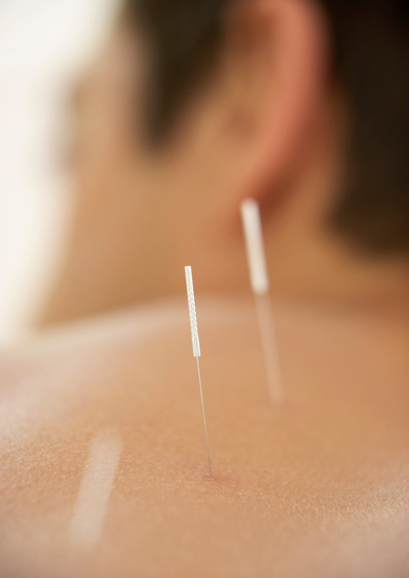 Cigonia | Center of expertise in perineal and pediatric rehabilitation | Acupuncture